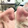 Коагуляция сосудов