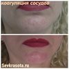 Коагуляция сосудов